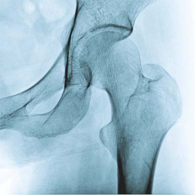 diagnózy bedrového kĺbu a ich liečba 