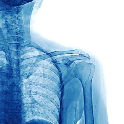 ochorenia a liečba ramenného kĺbu