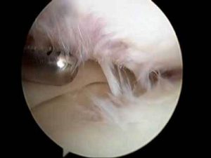 artroskopicý zákrok - koleno